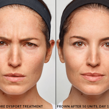 Home 52 DYSPORT (2×500 IU)